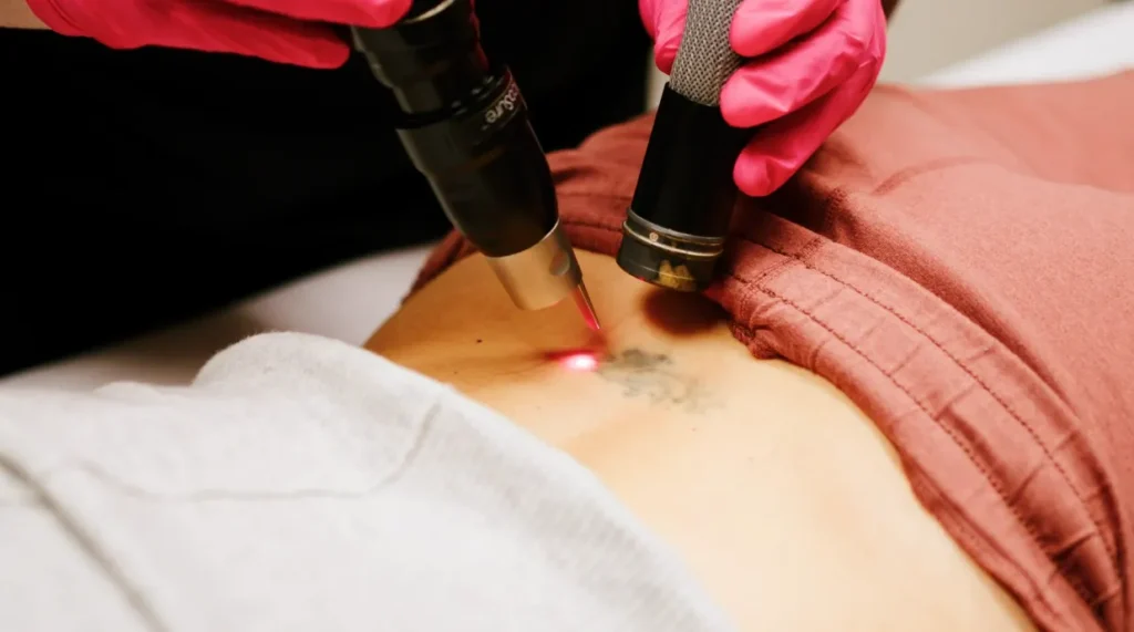 Tattoo Removal in Charlotte, NC at Infinity Medspa and Wellness