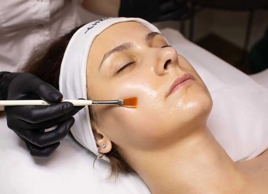 Chemical Peels Treatment in Charlotte, NC by Infinity MedSpa