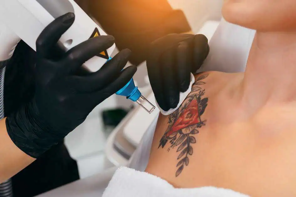 Laser Tattoo Removal Treatment in Charlotte, NC by Infinity MedSpa and Wellness