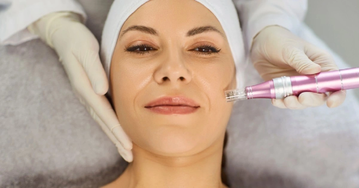Women receiving RF Microneedling Treatment in Charlotte, NC