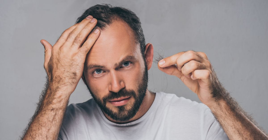 Man showing thinning hair; seeking Hair Loss Treatment in Charlotte, NC