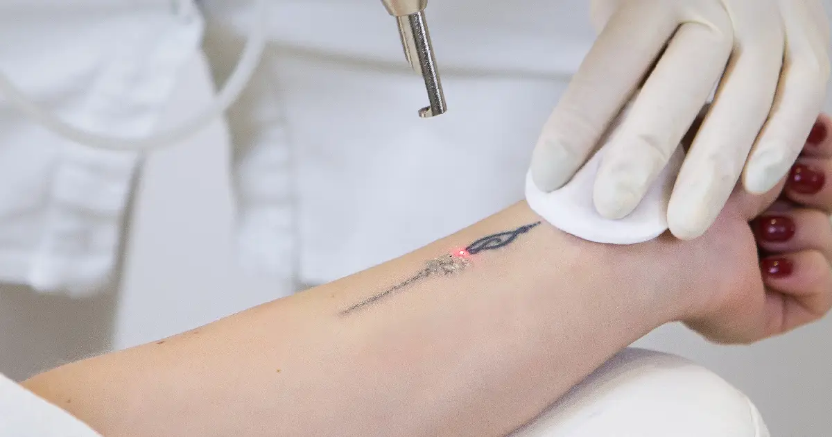Everything You Need to Know About Color Tattoo Removal