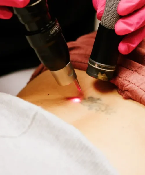 tattooremoval